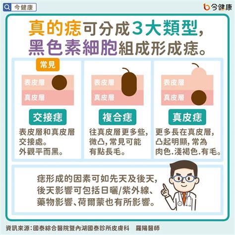 長毛痣|是痣？皮膚癌？還是什麼？常見Q&A解惑！醫教揪出「假的痣」